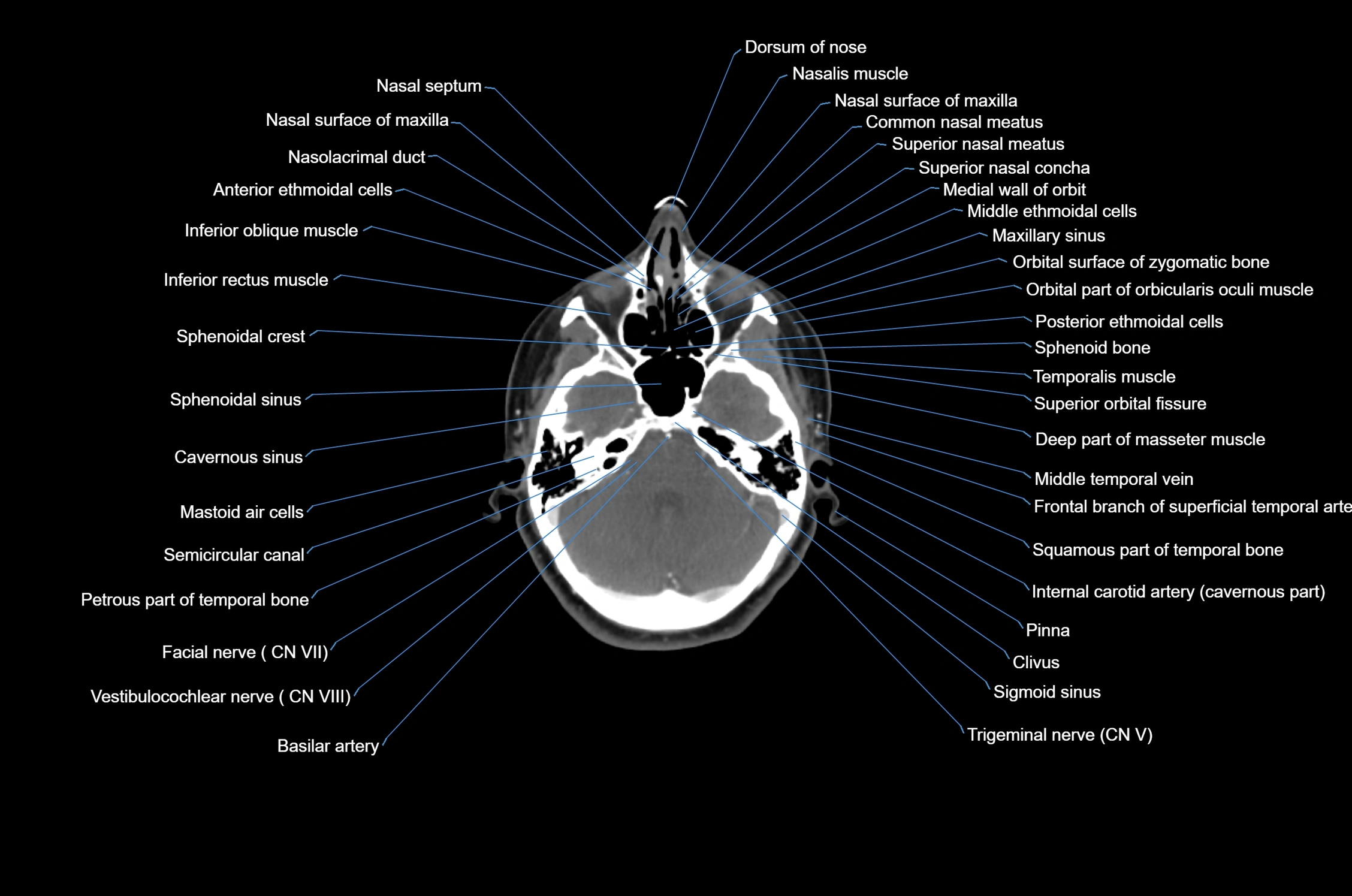 CT Neck axial cross sectional anatomy radiology image-img-00001-00011.webp